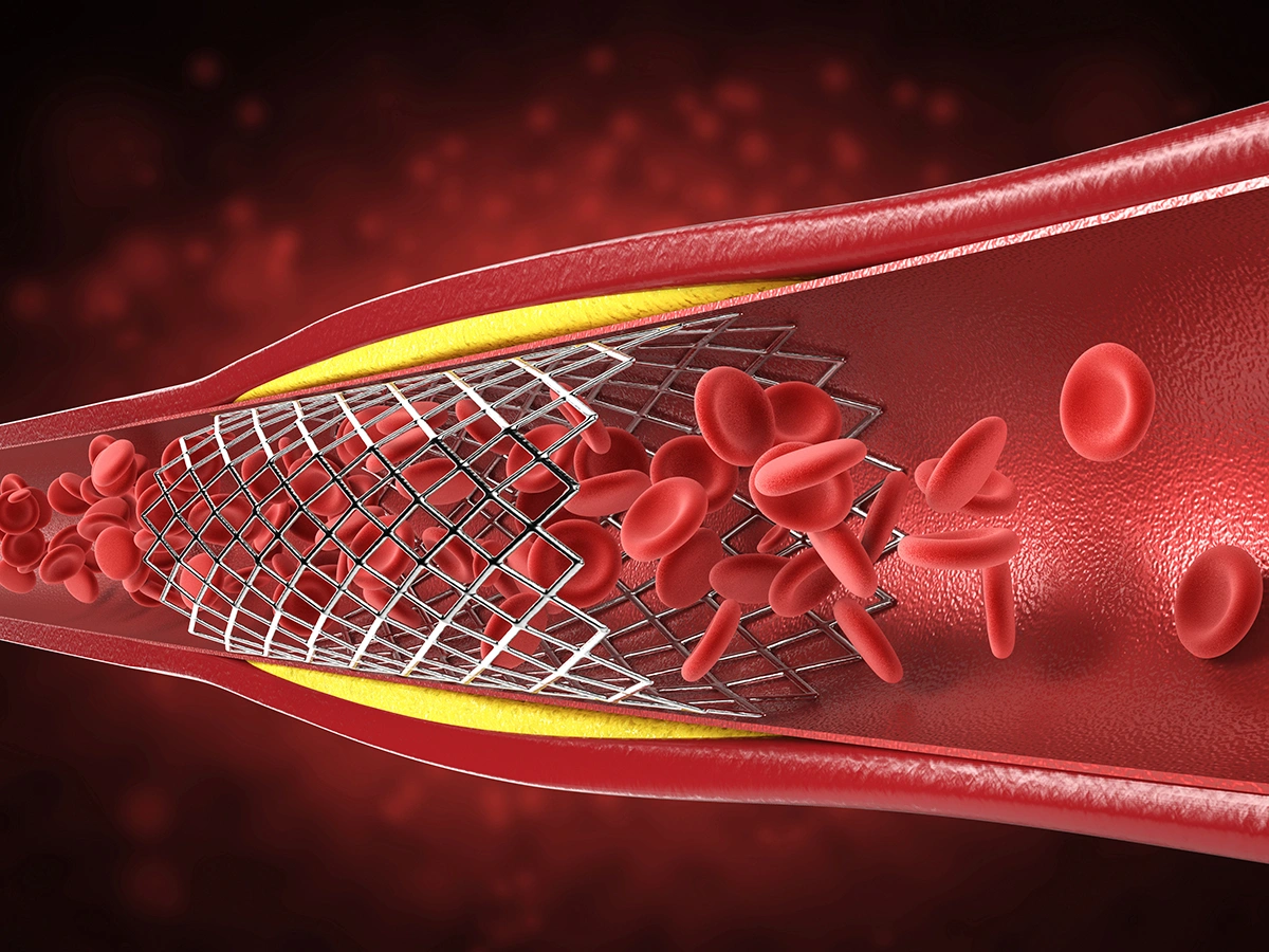 Unsure If You Need a Stent?  Get a Second Opinion